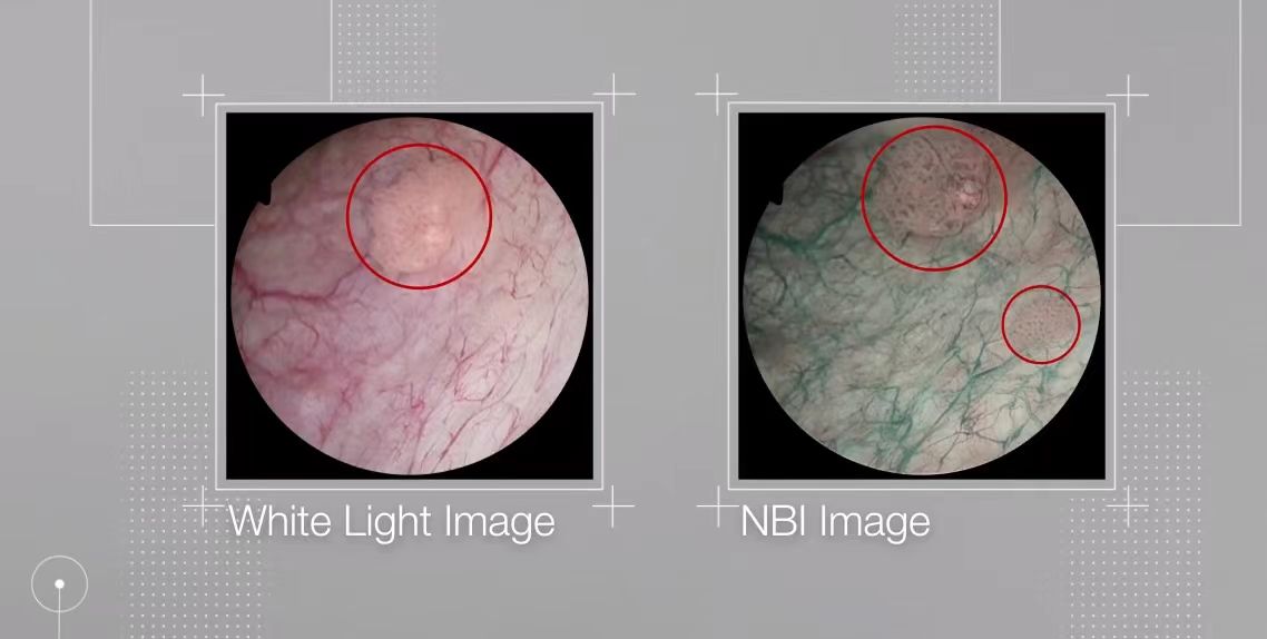 白光与 NBI 窄带成像对比
